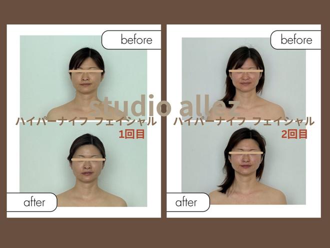 30代K様 ハイパーナイフ フェイシャルのビフォーアフター