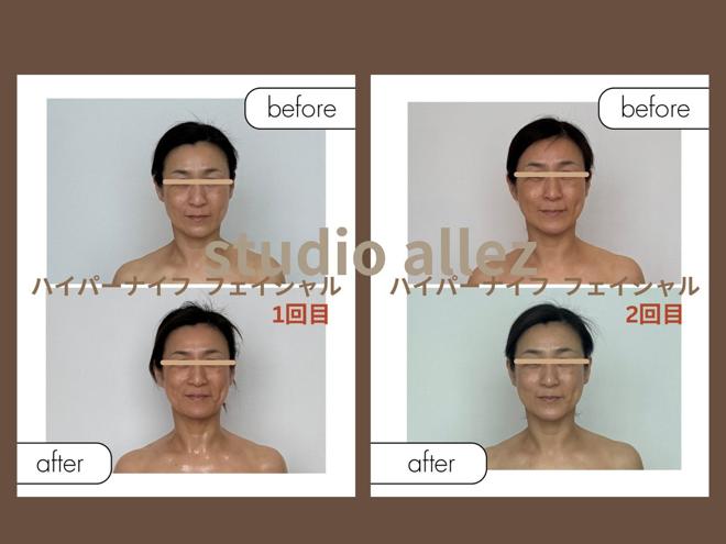 50代N様 ハイパーナイフ フェイシャルのビフォーアフター